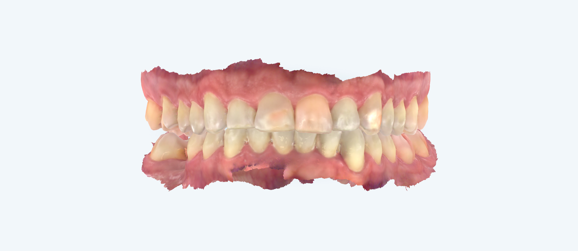 Overbite treatment comparison case 1 after